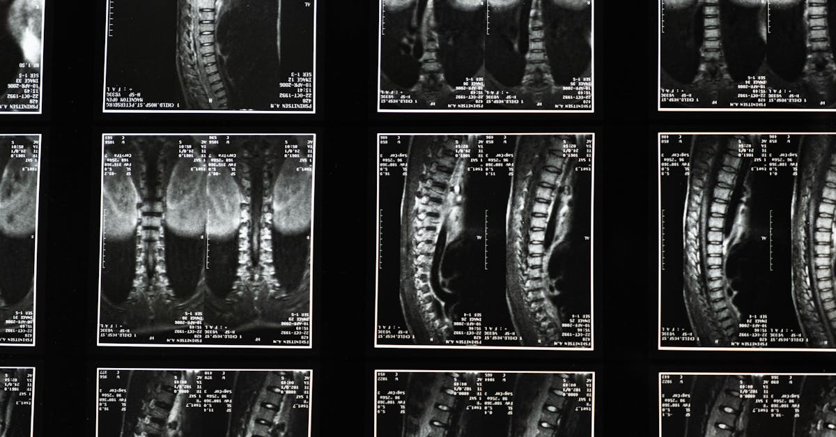 discover essential information about scoliosis, including its causes, symptoms, and treatment options. understand how this spinal condition can affect your health and learn effective management strategies for a better quality of life.