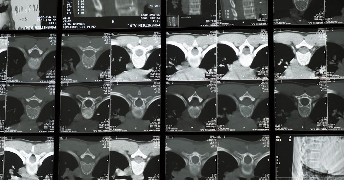 discover comprehensive insights into scoliosis, including causes, symptoms, treatment options, and management strategies for this spinal condition. learn how to improve quality of life and maintain a healthy spine.