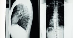 discover essential insights about scoliosis, its causes, symptoms, and treatment options. learn how this curvature of the spine can impact daily life and explore effective management strategies for a healthier back.