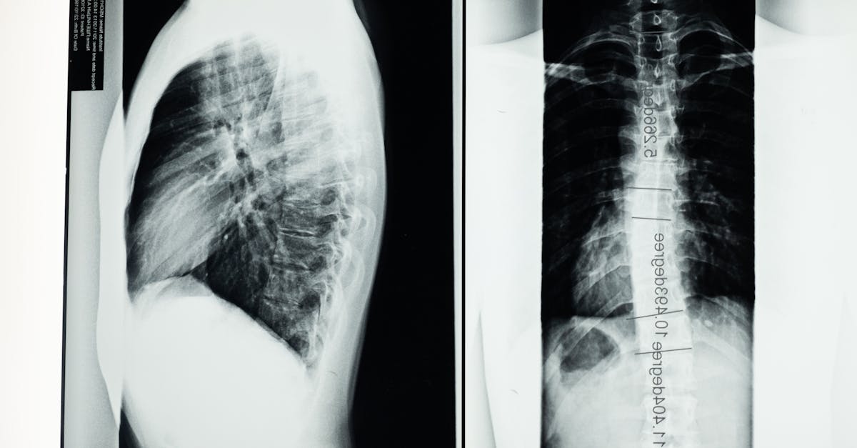discover essential insights about scoliosis, its causes, symptoms, and treatment options. learn how this curvature of the spine can impact daily life and explore effective management strategies for a healthier back.